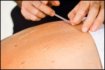 acupuncture-1024x680
